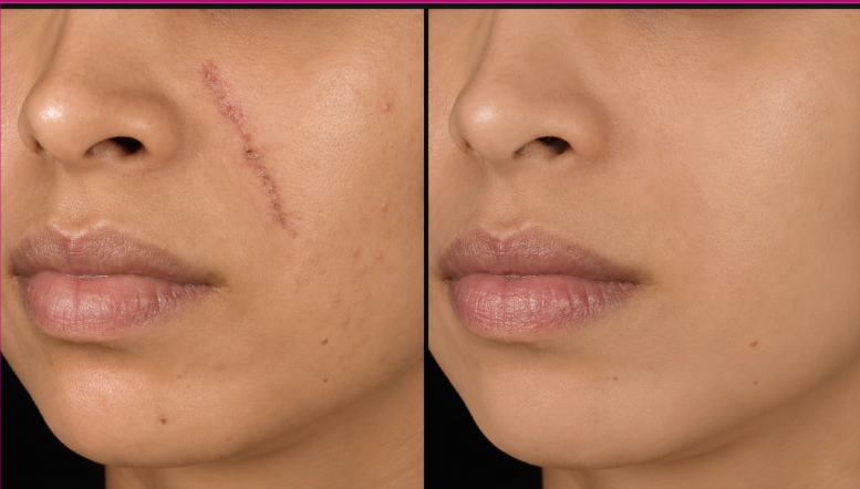 Cicatrizes de Acne